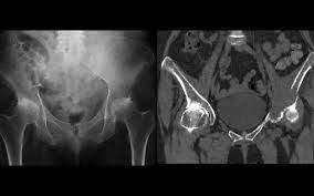 A pictorial review of diagnostic and. International Working Group Releases New Multiple Myeloma Imaging Guidelines Imaging Technology News