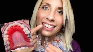 There is also a clear plastic alternative to the traditional wire bow hawley version available. Post Braces 3 Month S Reaction To Hawley Retainer Youtube