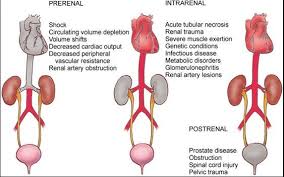 Image result for Postrenal Failure