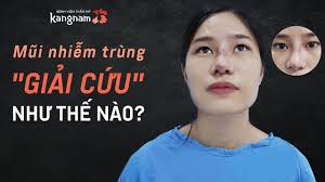 Nên tháo sụn mũi hay không? 6 dấu hiệu cho thấy bạn cần tháo sụn mũi