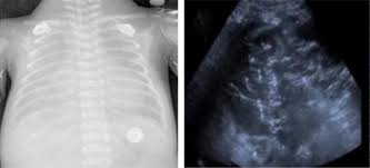 In rds the cxr will show. Lung Ultrasound As Early Diagnostic Tool In Neonatal Respiratory Distress Syndrome Rds Sciencedirect