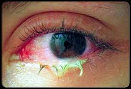 How To Get Rid Of Pink Eye 5 Natural Home Remedies Natural Pink Eye Remedy Pinkeye Remedies Pink Eye Treatment