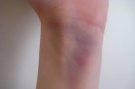 Oticanje upućuje na probleme s visokim tlakom nokti upozoravaju na bolesti srca i pluća, a peckanje u nogama može biti znak dijabetesa ili manjka vitamina b. Masnice I Posljedice Udaraca Tokom Sporta Salvia Kornati