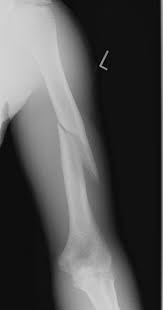 A Fracture Is The Medical Term For A Broken Bone They Occur When The Physical Force Exerted On The Bone Is Stronger Than Th Medical Knowledge Radiology X Ray