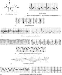 1920 x 1080 jpeg 934 кб. Premature Atrial Contraction An Overview Sciencedirect Topics
