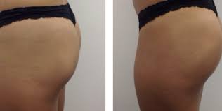 How much is a bbl in michigan. Sculptra Butt Lift Birmingham Butt Injections Oakland County Mi Face Beauty Science