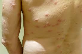 how to deal with bed bugs when travelling finding the universe
