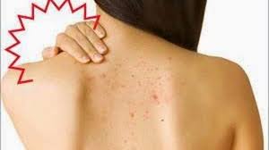 Pasalnya jerawat di badan bisa lebih parah daripada jerawat di wajah. Inilah 5 Penyebab Jerawat Di Punggung Berikut Solusinya Termasuk Diet Tribun Medan