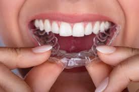 Conheca Os 5 Problemas Que O Invisalign Corrige Sng Odontologia