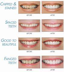 How long does dental bonding last. Bonding Moitoso Dental