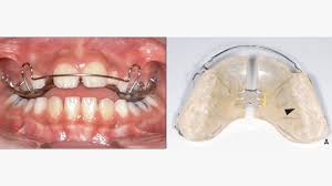 Soreness of certain teeth might be because of the elastic working on a proper alignment of upper and lower jaws. Bite Blocks For Braces What They Are And How They Work