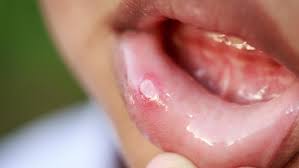 Camun beberapa penelitian yang dilakukan di sia tidak mendapatkan pasien h<b>!<b>#s. 5 Tanda Seseorang Terkena Hiv