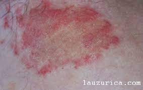Hongos En La Ingle Tina Inguinal O Tinea Cruris Cuaderno En Piel