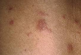 Image result for polymorphous eruption
