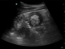 Image result for Adult Intussusception