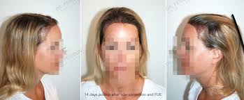 Grundsätzlich bestehende haare in die ruhephase fallen, was zur folge hat das man 1. Female Women Hair Transplant Hairforlife