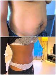 Diastasis Avec Relâchement Du Ventre : Quel Traitement ?