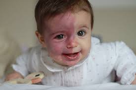 Resultado de imagen de enfermedades raras