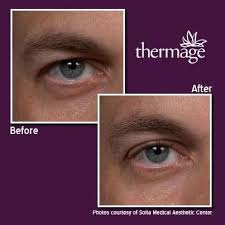 Solta medical, part of the ortho dermatologics business of bausch health companies inc., is a global leader in the medical aesthetics market . Thermage Cpt Eye Brow Lift Sydney Cbd Wahroonga Canberra Perth Ph 1300885808 Thermage Laser Skin Resurfacing Laser Vein Treatment