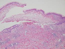 Image result for Pemphigoid