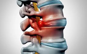 Image result for vyhřezlá ploténka