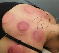 Again, no pain or tenderness is typically felt following a cupping treatment, whether or not discolorations appear on the skin. Nfl Teams Are Tackling Injuries With Acupuncture And Cupping Medill Reports Chicago