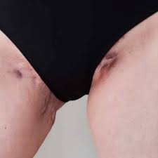 About Hidradenitis Suppurativa Hidrawear