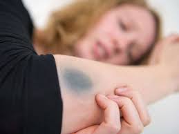 Wann Blutergusse Gefahrlich Werden Gesundheit