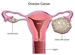 An ovarian cyst is a collection of fluid or air that develops in or around the ovary. Ovarian Cancer Dr Ulas Solmaz Izmir Oncologist Doctor