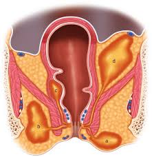 Image result for Ischiorectal Abscess