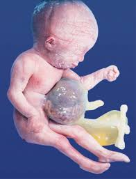 Image result for Umbilicus botryoides