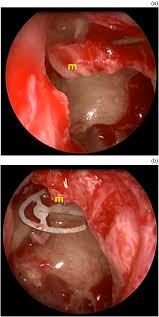 Image result for Ossicular Chain Disruption