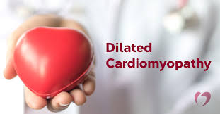 Image result for Cardiomyopathy