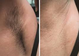 Amazing experience today at setty! Laser Hair Removal Reduce Unwanted Hair Dallas Fort Worth Texas