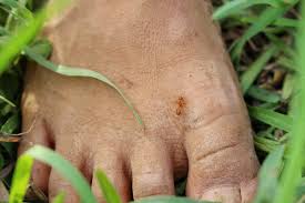 Image result for ant bite