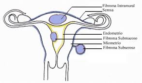 En raras ocasiones son canceroso, pero sí pueden causar dolor, sangrado y otros síntomas y podrían afectar tu posibilidad de quedar embarazada. Centro Para El Estudio De Los Fibromas Uterinos