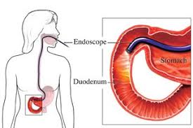Endoscopy describes many procedures that look inside the body using some type of endoscope, a flexible tube with a small tv camera and a. Endoscopy Nhs