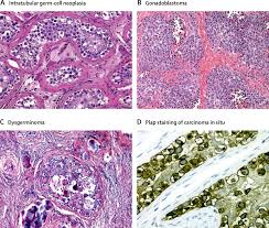 Generalized anxiety disorder in chronic fatigue syndrome // actapsychiatr scand. Supplemental Materials For Androgen Insensitivity Syndrome The Lancet