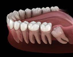 Dec 09, 2019 · many experts today believe that eating softer foods, especially as children, plays a role in impacted wisdom teeth. The Functions Of Molar And Wisdom Teeth