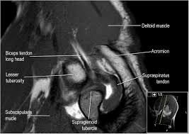 Injuries such as anterior cruciate ligament, meniscus and rotator cuff tears are all easily diagnosed when there is a firm understanding and knowledge of human anatomy. The Radiology Assistant Shoulder Anatomy Mri