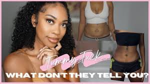 Tummy Tuck 4 month update