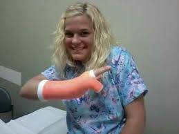 Image result for Ulnar Gutter Cast