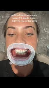 Is My Smile / Midline Crooked Or Is It Just In My Head? : R/Invisalign