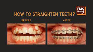 How long does metal braces take to straighten your teeth? How To Straighten Teeth With Braces Best Age To Start Braces Fms Dental Hospitals Youtube