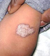 Tuberculosis) , the same bacterium that causes tuberculosis of the lungs ( pulmonary tb). Tuberculosis Cutaneous Dermatology Advisor