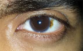 Jul 23, 2020 · some people develop a gray, white, or bluish circle around all or part of the colored part of the eyeball (called the cornea). X Paranormal Thread 19108105