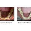 Inflamed tissue around the gums Https Encrypted Tbn0 Gstatic Com Images Q Tbn And9gcq Ftiedliqgabr6es33rc83g6osqag Lrnbxnnldgduliyd904 Usqp Cau