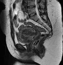 Adenomyosis is a medical condition characterized by the growth of cells that build up the inside of the uterus (endometrium) atypically located within the cells that put up the uterine wall (), as a result, thickening of the uterus occurs. Adenomyosis Wikidoc