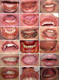 Image result for Erythema Multiforme Major