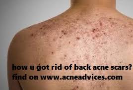Using a minor procedure called punch excision, your doctor cuts out individual acne scars and repairs the wound with stitches or a skin graft. How I Got Rid Of My Back Acne Scars Naturally Is Beneficial Acne Advices